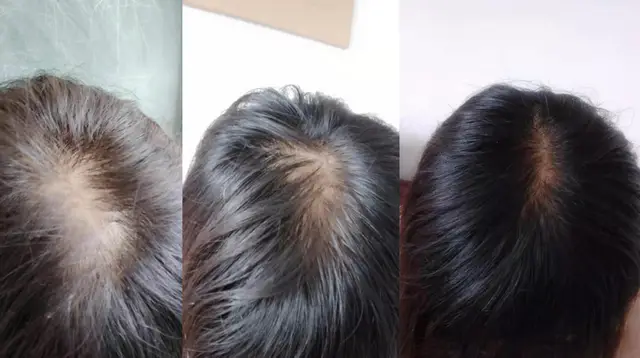 Comprehensive Analysis of Early-Onset Alopecia